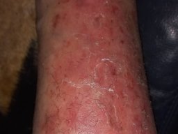 psoriasis